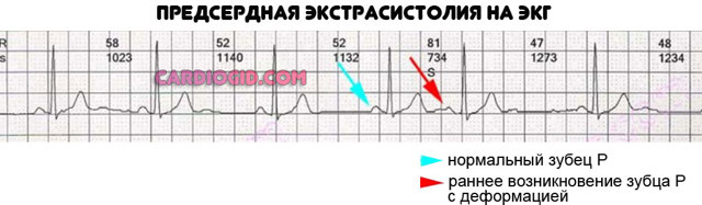 Предсердная экстрасистолия: какие симптомы, причины и лечение