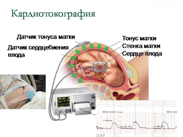 КТГ при беременности — расшировка, норма и когда делают?