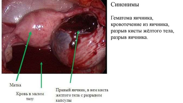 Фолликулярная киста яичника - симптомы, лечение, причины
