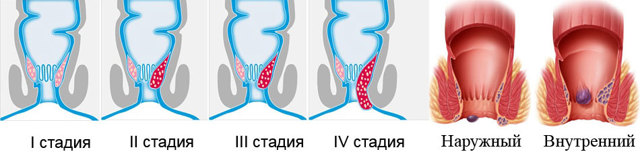 Йога при геморрое, йога против геморроя – упражнения