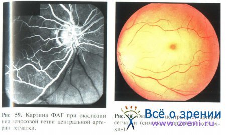 Ишемические заболевания сетчатки глаза и зрительного нерва