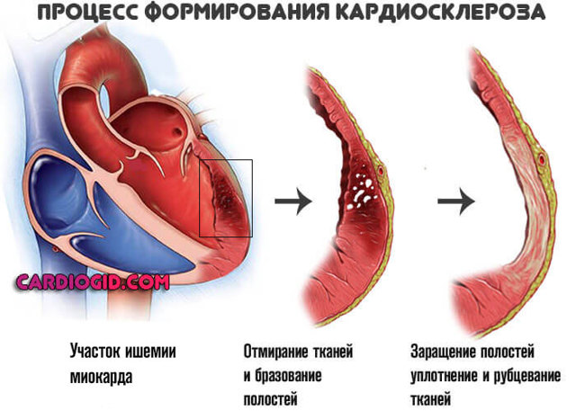 Высокое нижнее давление: причины и лечение