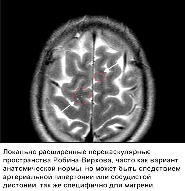 Единичные очаги в белом веществе головного мозга - результаты МРТ