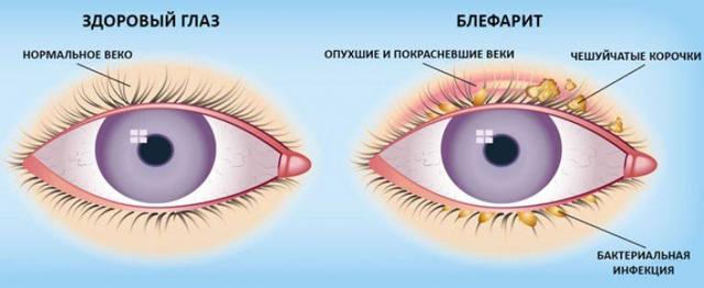 Глазные капли Ципромед: инструкция по применению