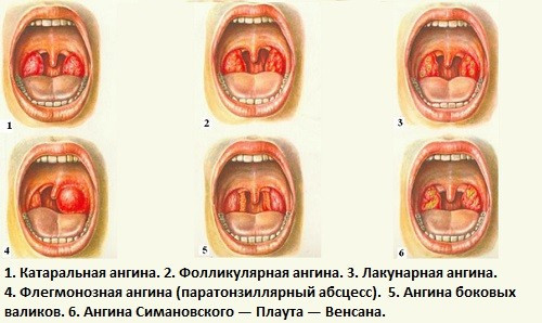 Тонзиллит: виды, фото, лечение и симптомы