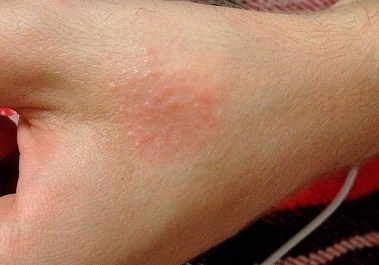 Красные пятна на теле у взрослого - появились красные пятнышки на лице