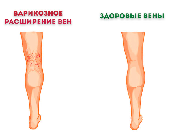 Детралекс побочные явления