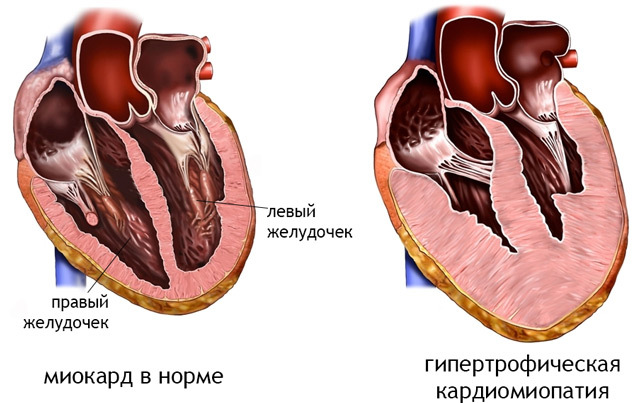 Индекс массы миокарда норма