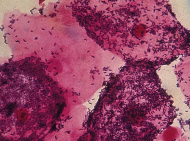 Гарднерелла у женщин - откуда появляется? Симптомы и лечение гарднереллёза