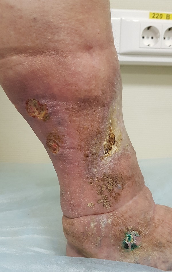 Трофические язвы нижних конечностей: виды, симптомы, лечение