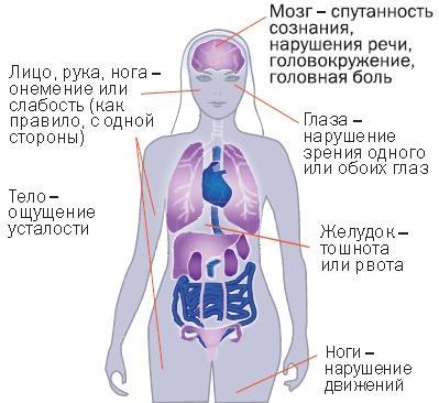 Что такое Острое нарушение мозгового кровообращения?