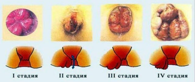 Можно ли плавать в бассейне при геморрое — Сайт о геморрое
