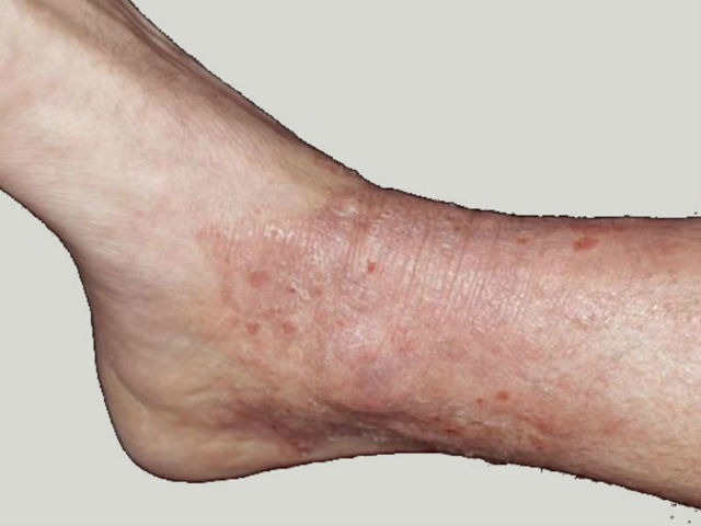 Нейродермит у взрослых и детей: симптомы (фото), лечение