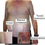 Уколы Дипроспан: инструкция по применению, цена, отзывы и аналоги