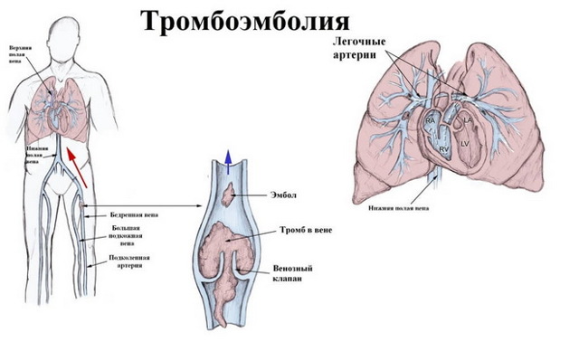 Тромбоэмболия: виды, причины, симптомы артериальной и венозной, лечение