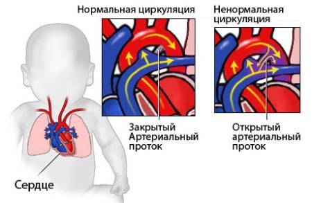 Врожденный порок сердца у новорожденных детей: что это, причины, последствия, классификация и лечение