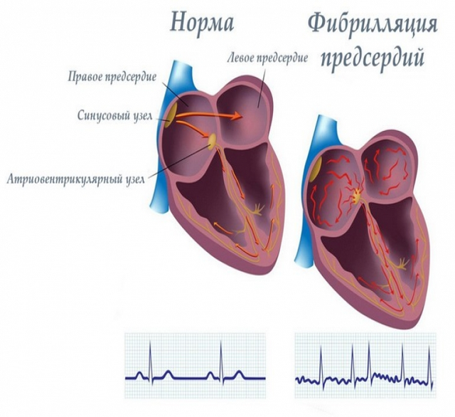 Классификация фибрилляции предсердий