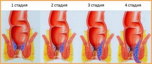 Обезболивающее при геморрое - список препаратов и народных средств для снятия боли в домашних условиях