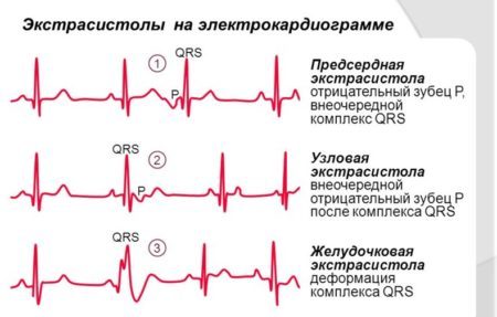 Экстрасистолия при остеохондрозе - что это такое и как лечить