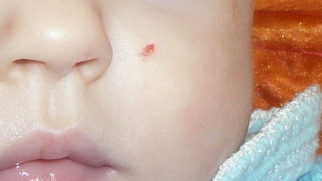 На лице у ребенка полопались сосуды - Все про гипертонию