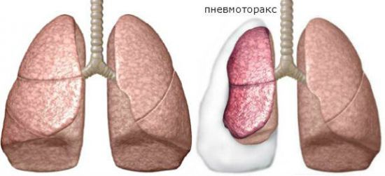 О чем говорит боль в грудной клетке посередине при вдохе? О чем говорят боли в грудной клетке при вдохе