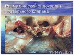 Трикуспидальная регургитация — степени и лечение