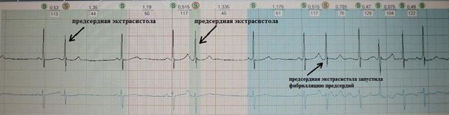 Желудочковые экстрасистолы норма