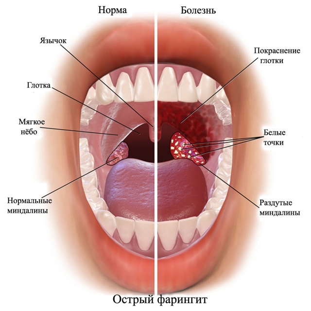 Фарингит – острый и хронический. Симптомы и лечение фарингита.