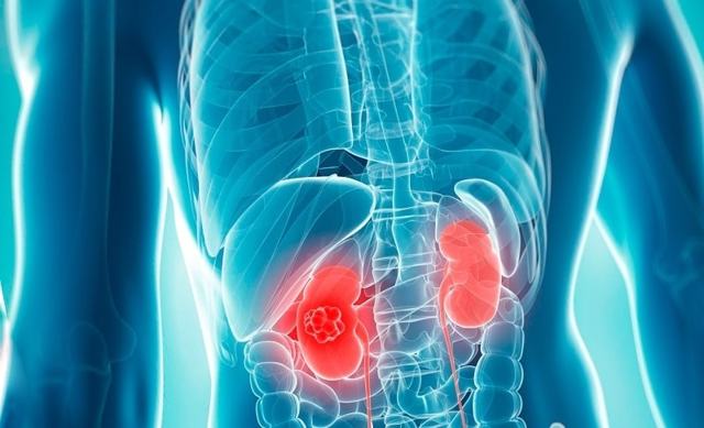 Осложнения после стентирования сосудов сердца и коронарных артерий - компания Стентоник