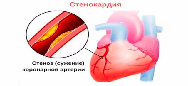 Тропонин в крови: что это, виды (T, I, C), нормы, повышение в анализах, уровень при инфаркте. 3 правила подготовки к проведению тропонинового теста
