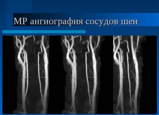 МРТ сосудов - МР-ангиография головы, МРТ сосудов шеи, аорты