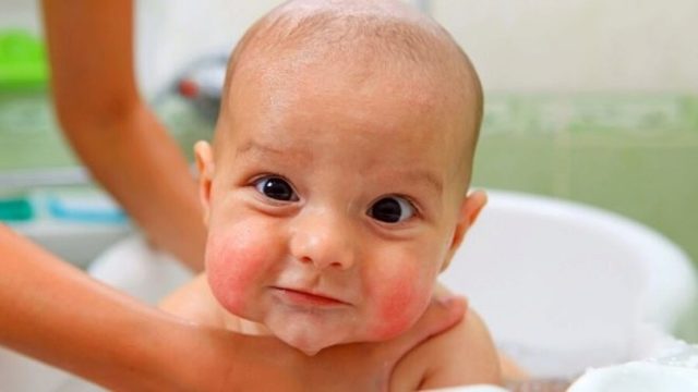 Эритема у детей и взрослых: симптомы, фото, лечение