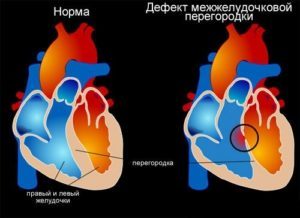 Неполная межжелудочковая перегородка имеется в сердце - Универ soloBY