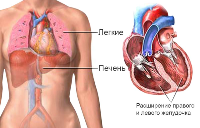 Миокардит - причины, симптомы, диагностика и лечение