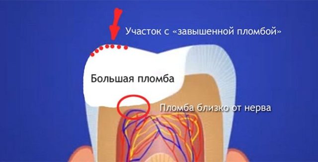 Почему болит зуб после пломбирования каналов - обзор причин