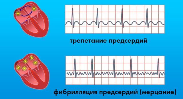 Картинки ЭКГ при нарушениях ритма