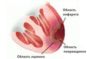 Микроинфаркт - причины, признаки, симптомы и лечение