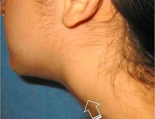 Внутренняя сонная артерия