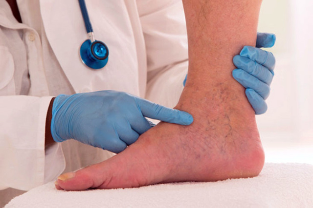 Отеки ног при сердечной недостаточности