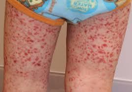 Васкулит на ногах - что это такое и как лечить?