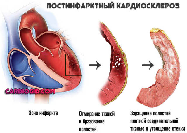 Мерцательная аритмия: причины, симптомы и лечение