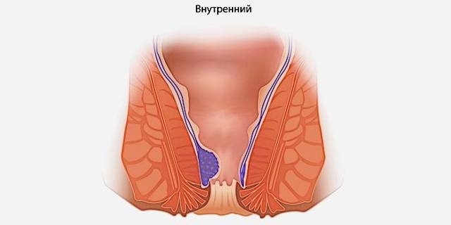 Что нужно делать если геморрой вылез наружу и болит