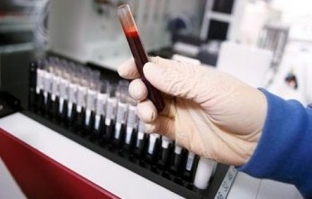 Сыворотка крови человека: что это, отличие от плазмы