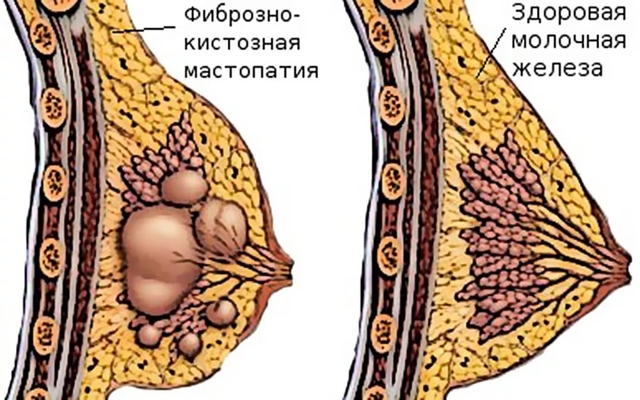 Болит грудь сбоку: причины и симптомы