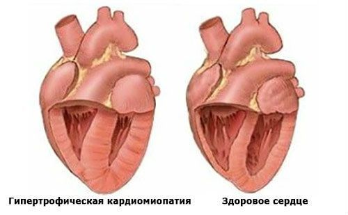 Колит в левом боку под ребрами спереди при вдохе, в области сердца, сбоку, сзади. Что это может быть у женщин, мужчин