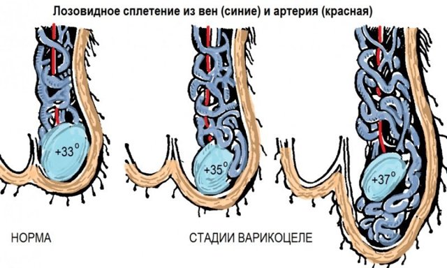 Варикоз на яичках: основные проявления