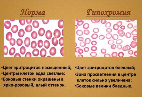 Гипохромия в общем анализе крови – что это такое?