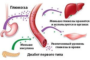 Что такое Инсулинозависимый сахарный диабет?