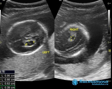 Киста сосудистого сплетения головного мозга: возникновение, диагностика, лечение. Опасна ли киста сосудистого сплетения для новорожденного?