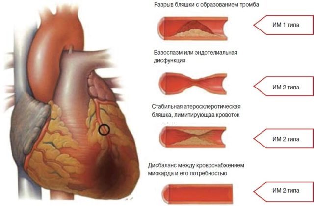 Тромб в сердце: что это такое, симптомы и что делать
